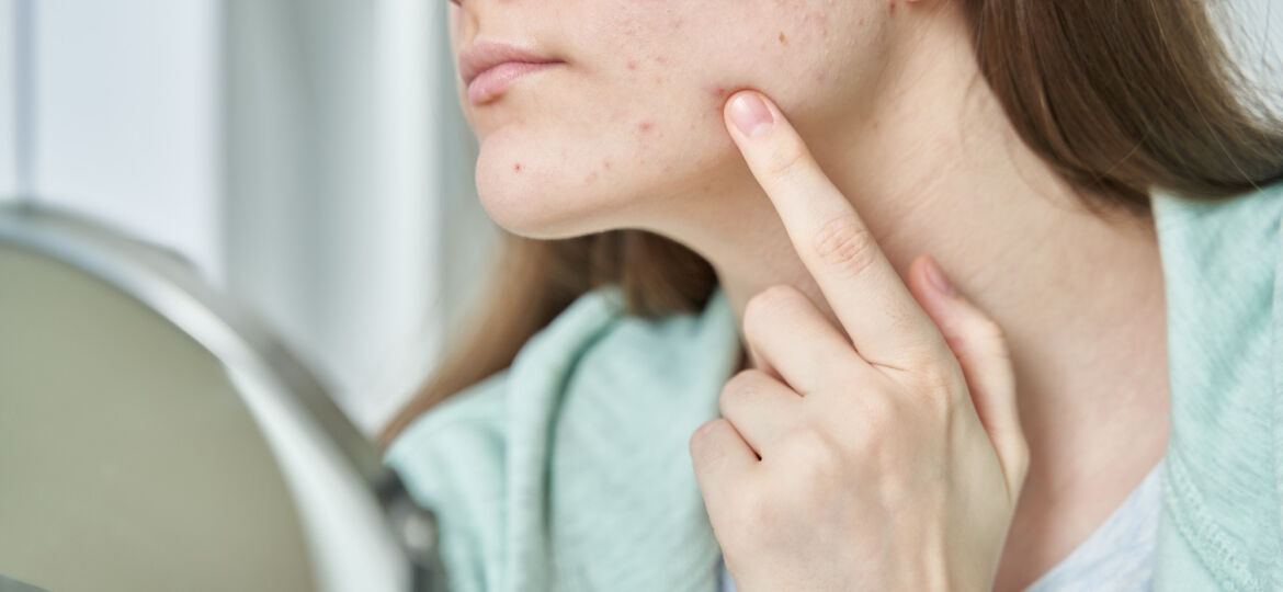 Sovrappeso, Acne, Alterazioni del ciclo mestruale