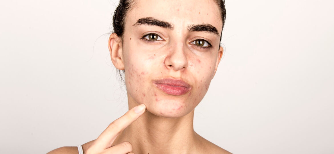 Acne, resistenza all’insulina e sindrome metabolica